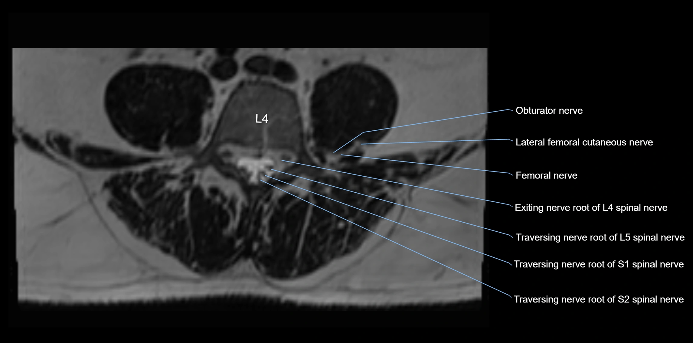 MR lumbosacral plexus axial cross sectional anatomy 3T  radiology  image-img-1008001-00040.webp